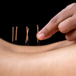 acupuntura para dolor de espalda