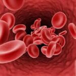 Anemia in Dubai