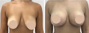 H1-Breast-reduction