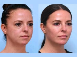 Enhance Natural Radiance with Expertly Performed Thread Lift Treatments in Dubai