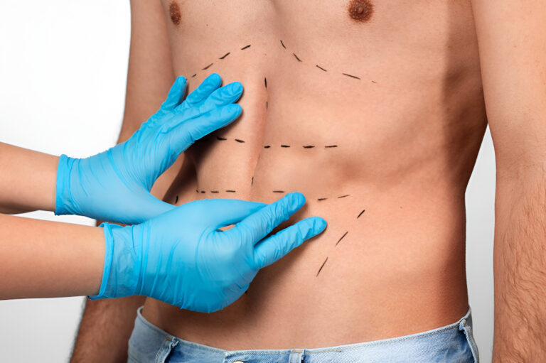 Liposuction in Islamabad