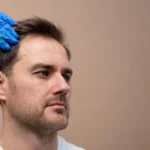 PRP therapy hair treatment