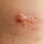 Top 5 Natural Treatments for Bullous Pemphigoid
