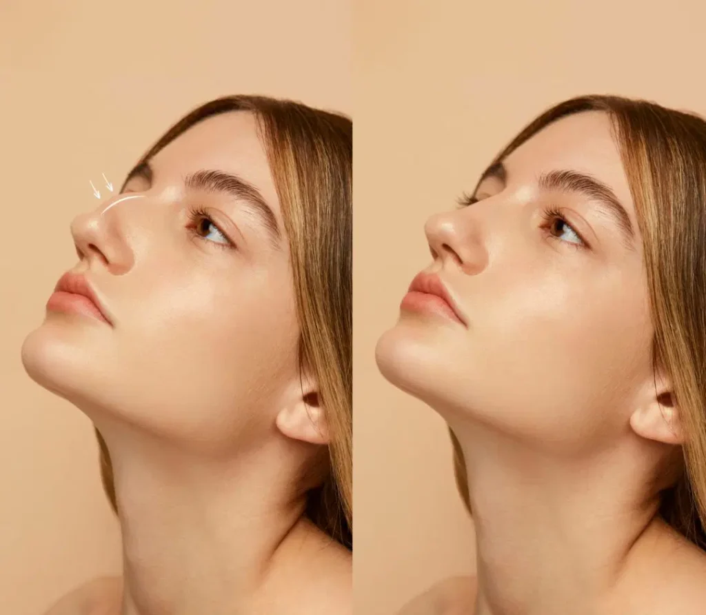 What-Age-Can-You-Get-Rhinoplasty-Nose-Job-In-Dubai-scaled