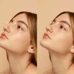 What-Age-Can-You-Get-Rhinoplasty-Nose-Job-In-Dubai-scaled