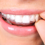 Next-Level Orthodontic Care for a Straighter, Healthier Smile Teeth Aligners in Pakistan: