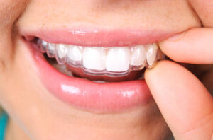 Next-Level Orthodontic Care for a Straighter, Healthier Smile Teeth Aligners in Pakistan: