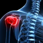 stem-cell-treatment-and-torn-rotator-cuff-2