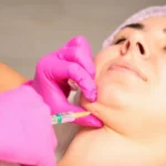 Kybella san ramon