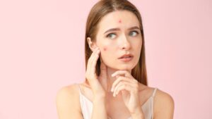Acne Treatment in Dubai: How to Choose the Right Treatment for Your Skin Type