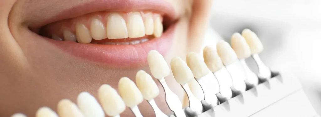 Are Ceramic Veneers Right for You