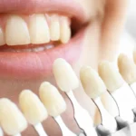 Are Ceramic Veneers Right for You