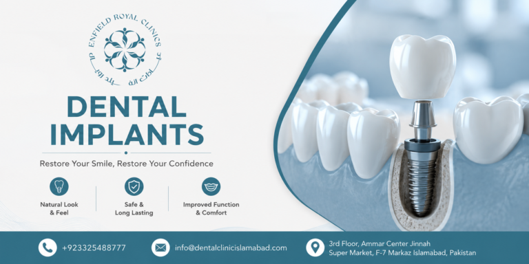 Best Dental Implants in Islamabad