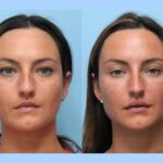 Best Doctors in Dubai Specialize in Thread Lift for Natural Youthful Results