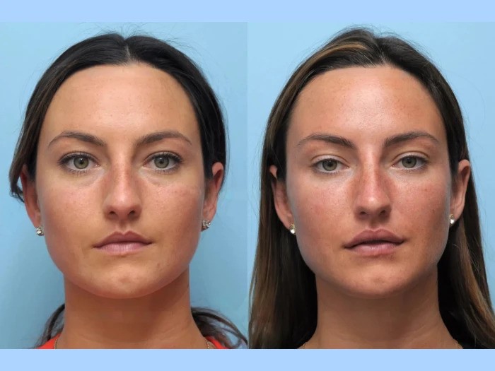 Best Doctors in Dubai Specialize in Thread Lift for Natural Youthful Results