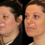 sculptra in dubai