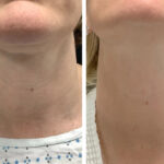 Best Doctors in dubai Using Radiofrequency Microneedling Innovation