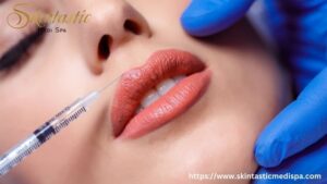 Lip Fillers Riverside