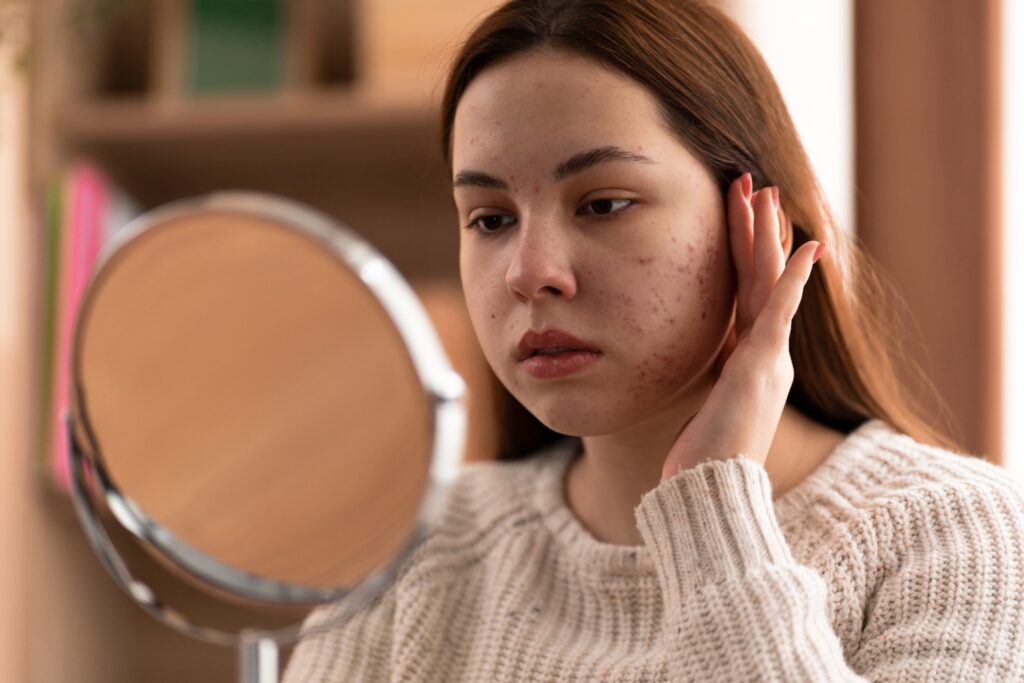 acne scar treatment Toronto
