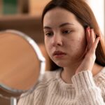 acne scar treatment Toronto