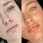 fillers