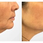 Non Surgical Thread Lift Treatment in Dubai for Smoother Youthful Skin Appearance