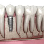 Dental Implants Hertfordshire