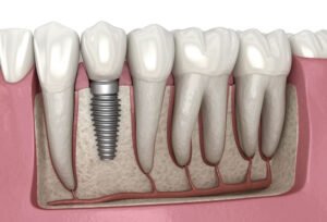 Dental Implants Hertfordshire
