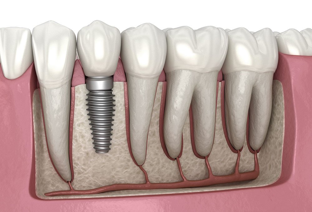 Dental Implants Hertfordshire