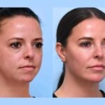 Best Doctors in Dubai Perform Thread Lift Treatments for Smoother Tighter Skin
