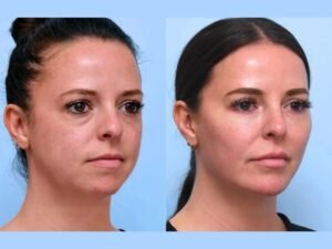 Best Doctors in Dubai Perform Thread Lift Treatments for Smoother Tighter Skin