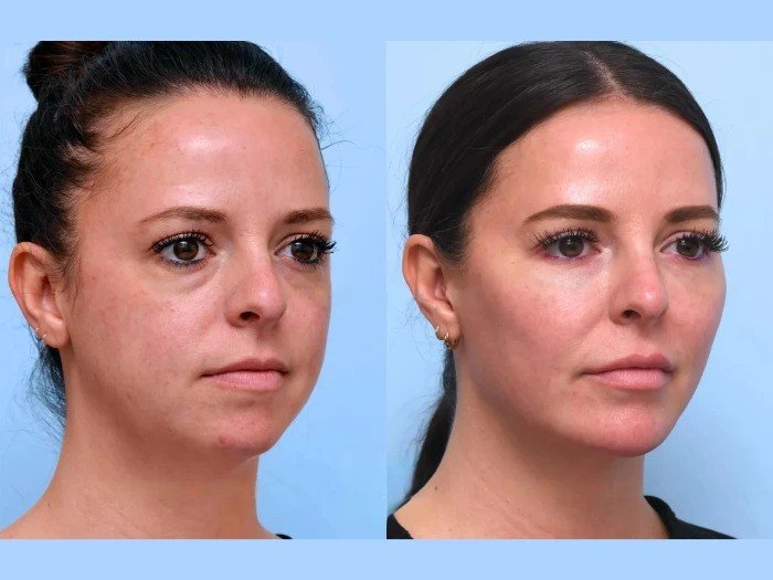 Best Doctors in Dubai Perform Thread Lift Treatments for Smoother Tighter Skin