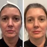 Best Plastic Surgeon in Dubai: Facial Contouring Face and Neck Through Modern Thread Lift