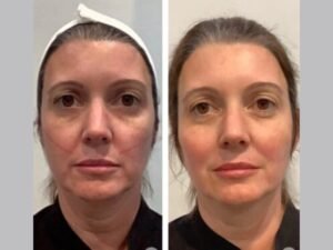 Best Plastic Surgeon in Dubai: Facial Contouring Face and Neck Through Modern Thread Lift