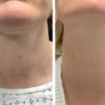 Best Plastic Surgeon in dubai for Safe Radiofrequency Microneedling Procedures