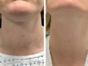 Best Plastic Surgeons in dubai for Safe Radiofrequency Microneedling Procedures