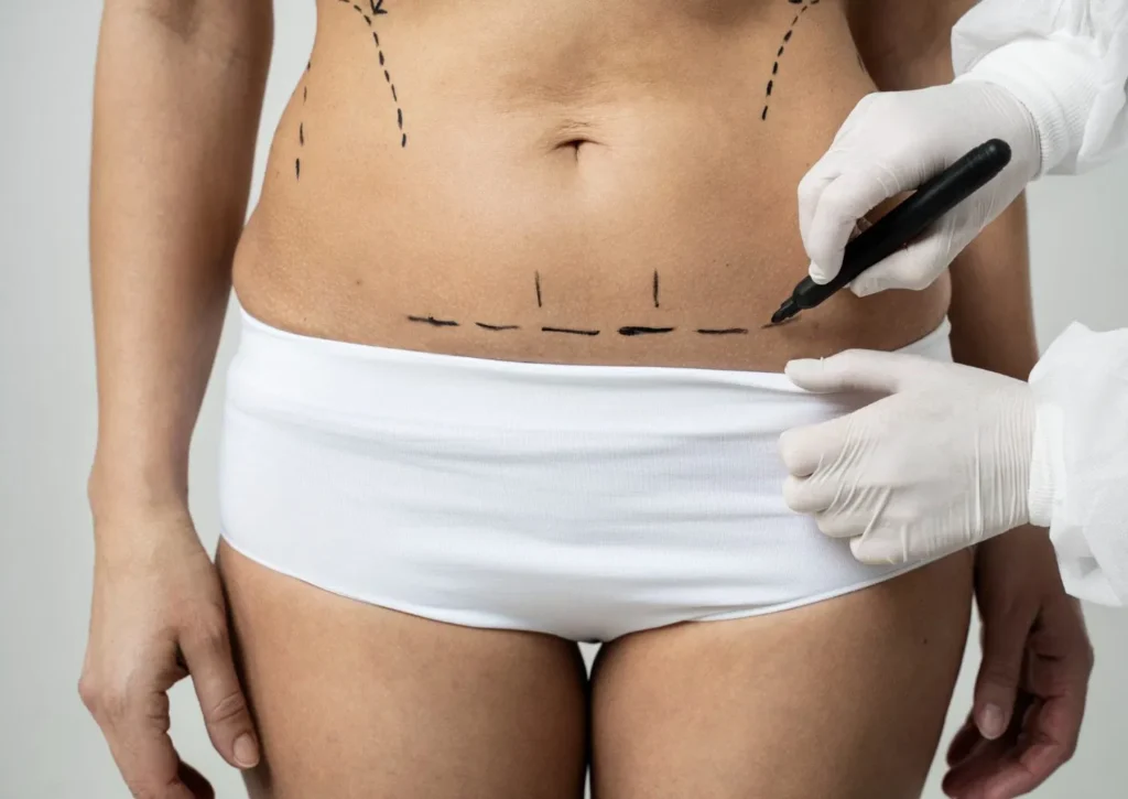 Mini-Tummy-Tuck-Dr.-shahram-e1708978805979