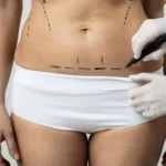 Mini-Tummy-Tuck-Dr.-shahram-e1708978805979