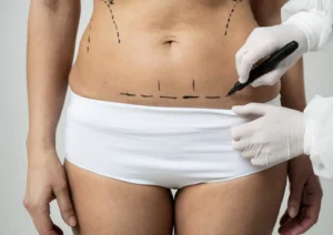 Mini-Tummy-Tuck-Dr.-shahram-e1708978805979