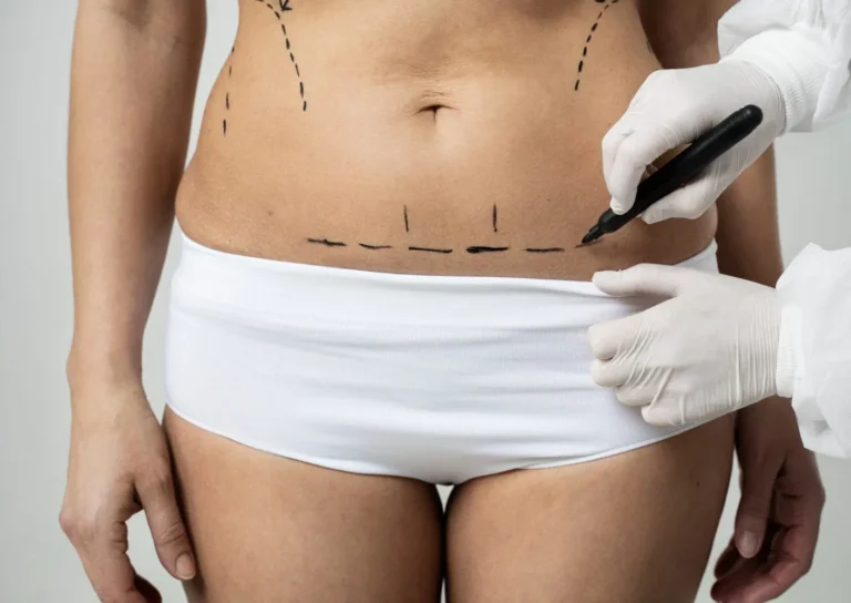Mini-Tummy-Tuck-Dr.-shahram-e1708978805979