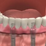 Rebuild Your Confidence with Full Mouth Dental Implants in Houston