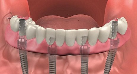 Rebuild Your Confidence with Full Mouth Dental Implants in Houston