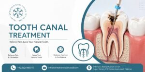 Tooth Canal Treatment in Islamabad