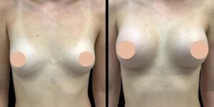 Breast Augmentation Surgery in Dubai: Signs of a Healthy Recovery Process
