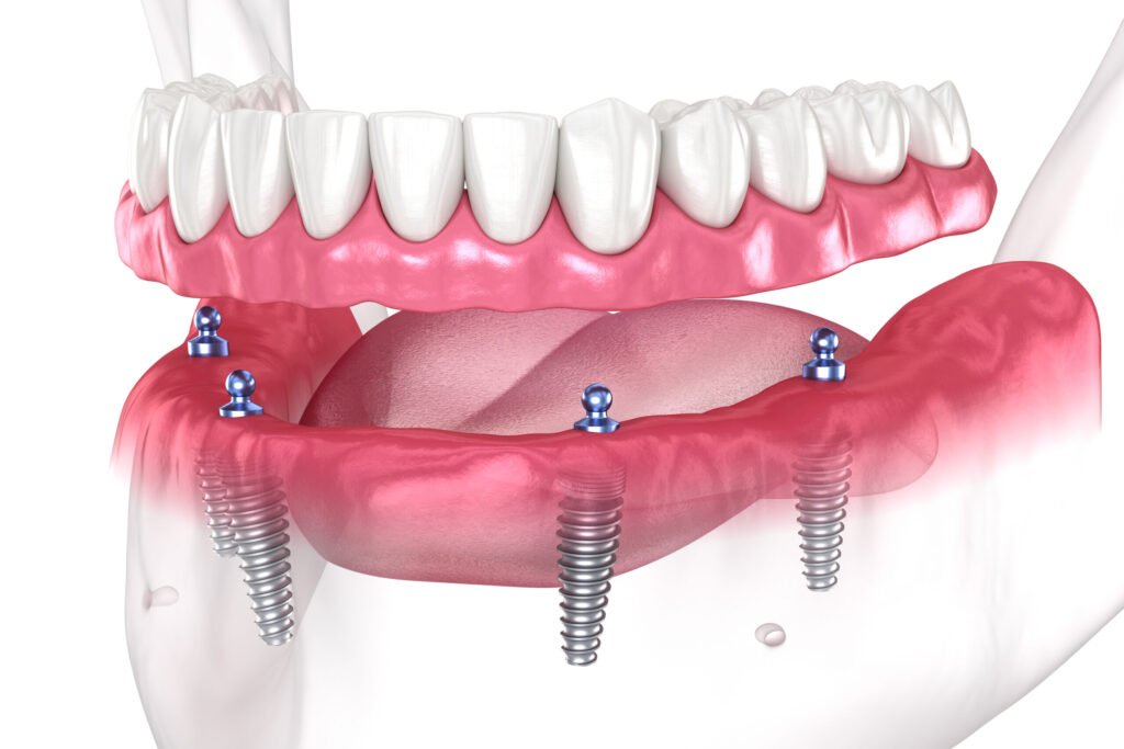 Smile Without Breaking the Bank: Affordable & Mini Dental Implants in Houston