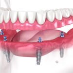 Smile Without Breaking the Bank: Affordable & Mini Dental Implants in Houston