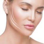 endolift