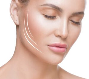 endolift