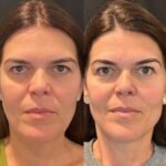 Advanced Thread Lift Treatment in Dubai for Smoother Lifted Facial Contours