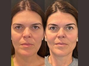 Advanced Thread Lift Treatment in Dubai for Smoother Lifted Facial Contours